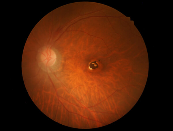 Scan of Macular Hole