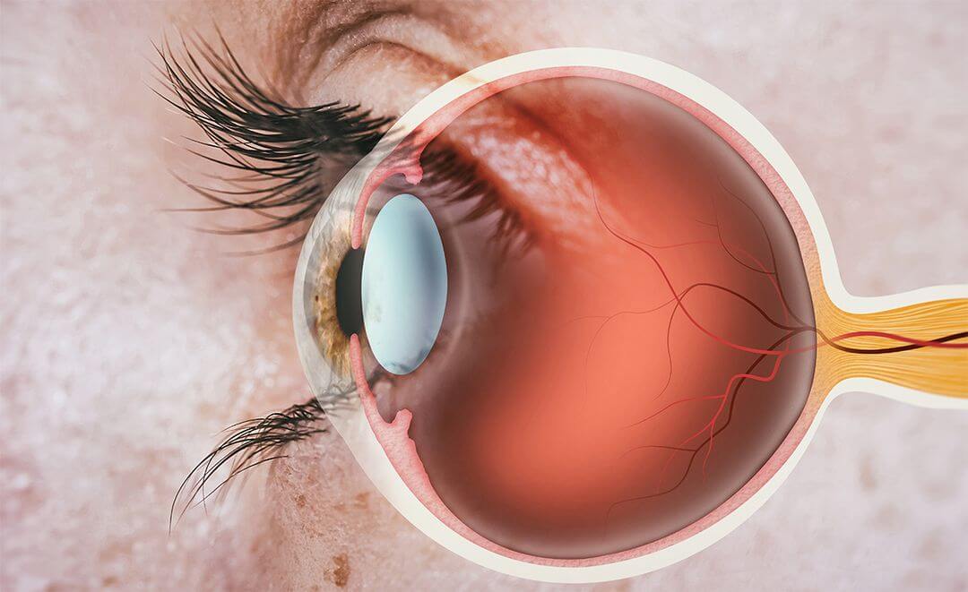 Retina Word Ophthalmologist Bonita Springs | Retina Specialist Naples