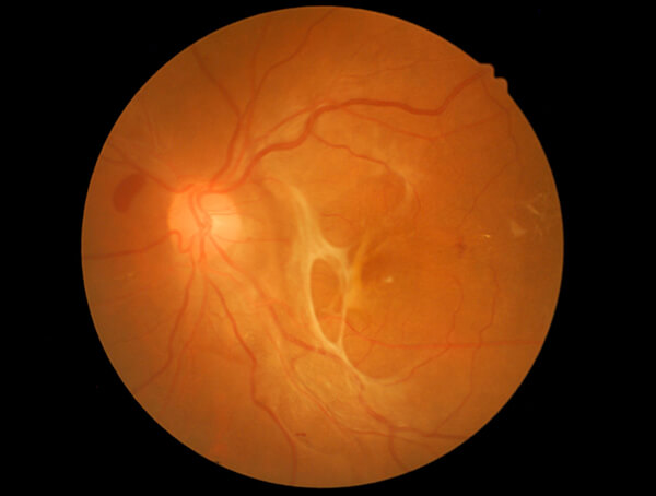 Scan of Retinal Detachment