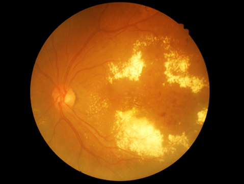 Retinal scan showing diabetic retinopathy
