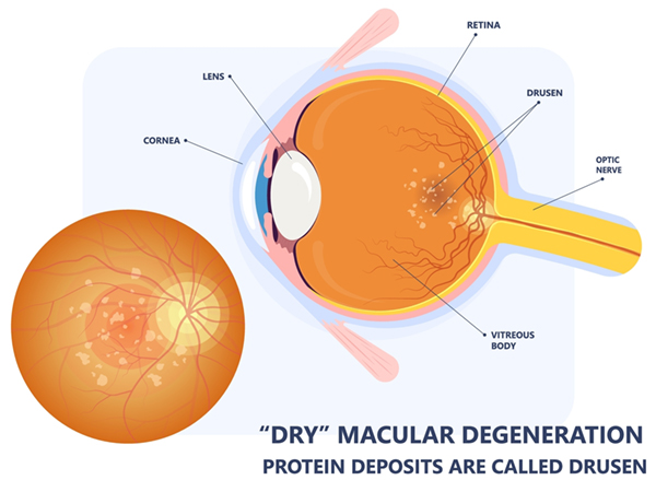 Diagram showing an eye with "dry" macular degeneration