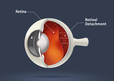 Retinal detachment diagram
