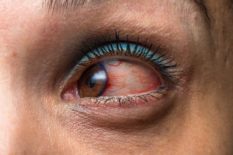 Red eyes are a symptom of Uveitis