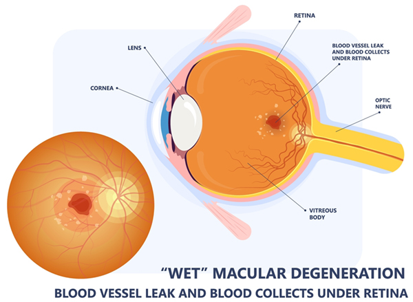 Diagram showing an eye with "wet" macular degeneration